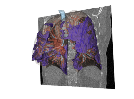 Qureight&rsquo;s synthetic study arms validate clinical efficacy in pioneering rare lung disease treatment